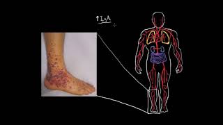 Henoch-Schöolein Purpurası Fen Bilimleri Sağlık Ve Tıp