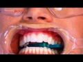 How To Go About Getting Whiter Teeth