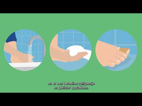 Video: Hoe een infectie van een ingegroeide teennagel te verwijderen: 9 stappen