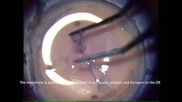 Final EBAA 2012 DMEK video