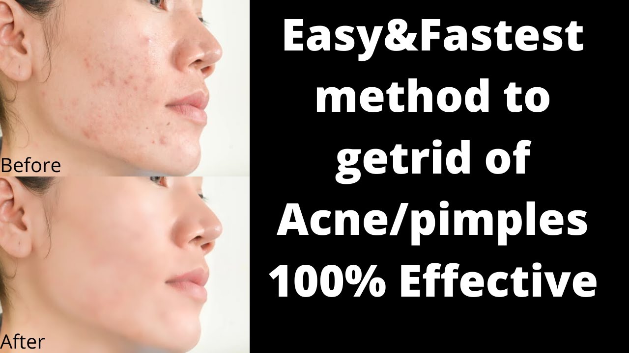How to Get rid of pimples overnight|acne|pimple marks|pimple removal at home|acne