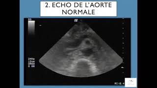 Aorte Abdominale Aorte Abdominale