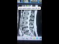 Avoid spinal surgery: non‑invasive decompression heals L5‑S1 herniation #spine #recovery
