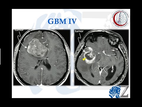 Brain Tumours (6):  Gliomas (4):  GBM IV  أورام المخ الدبقية/النجمية