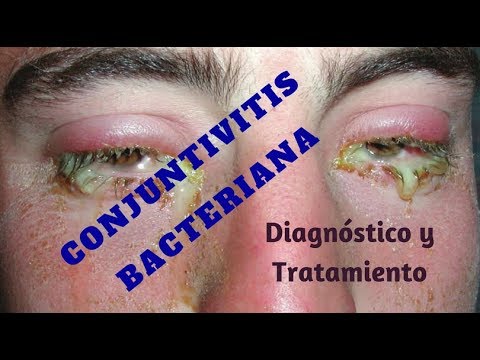 conjuntivitis bacteriana sintomas y signos