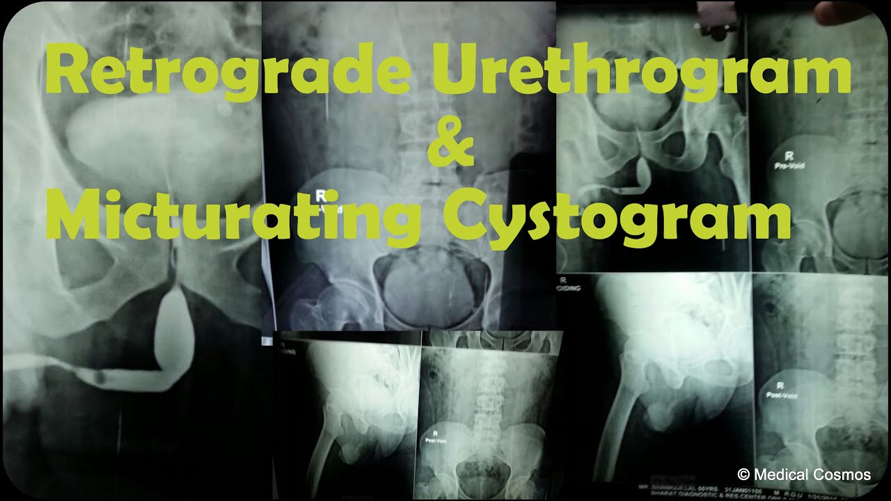 RGU MCU [Retrograde Urethrogram and Micturating Cystogram] Case