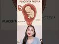 Placenta previa in pregnancy #shortvideo #placentaprevia