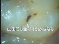 小さい虫歯は削ったらダメ！！