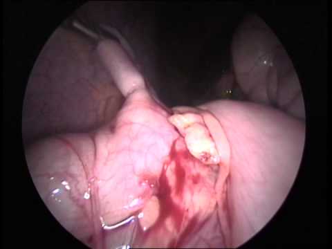 Lap. Appendectomy (unedited-24)-Acute Appendicitis, Simple Inflamed, Hemolock Clips Used