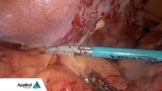 New Algorithm Laparoscopic Sigmoidectomy featuring the Voyant® Maryland Fusion device