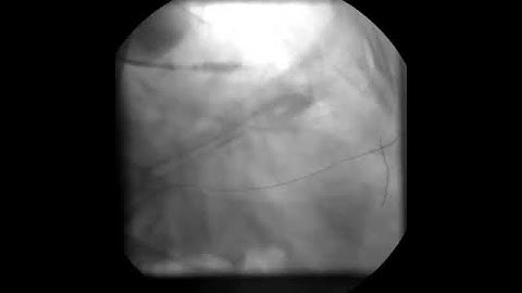 Phẫu thuật đặt stent tim