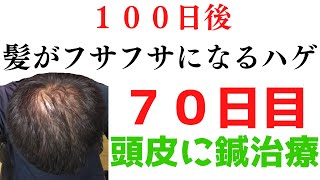 【７０日目】１００日後、髪の毛フサフサ（飲み薬無し）電気ブラシ【AGA治療・若ハゲ・女性ハゲ・M字ハゲ・薄毛・円形脱毛症】フォリックスFR１２・１５（ミノキシジル・フィナステリド）育毛剤・発毛剤