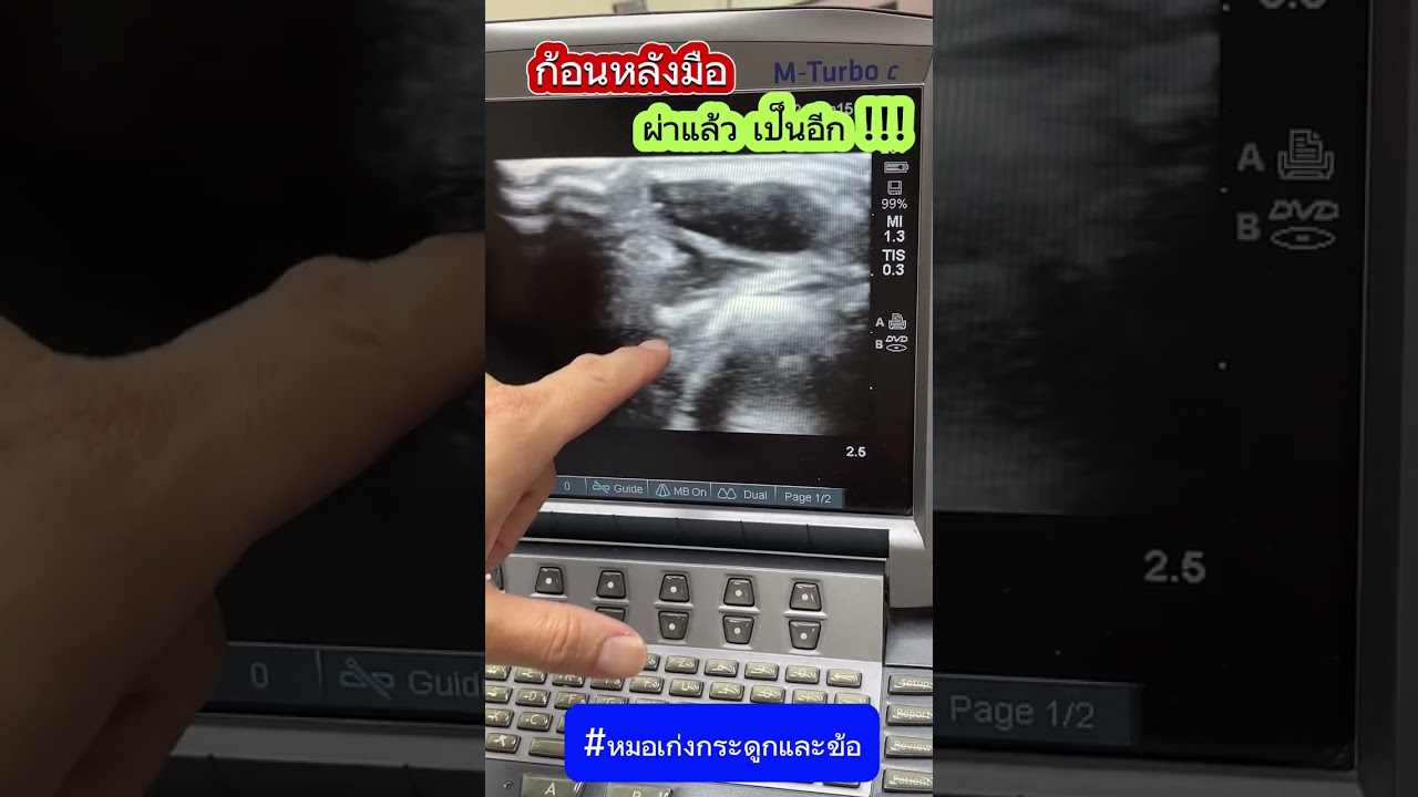 ก้อนหลังมือ ผ่าแล้วเป็นอีก !!! #หมอเก่งกระดูกและข้อ #ก้อนที่หลังมือ #ก้อนถุงนํา้ข้อมือ #ปวดข้อมือ