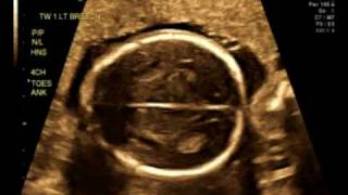 20_Weeks_1b.avi