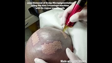Great video of Laser Removal of SMP - Scalp Micropigmentation by Carl Barton of The Laser Studios UK