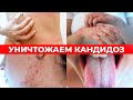 Как убить кандиду? 6 средств, которые УНИЧТОЖАТ грибок