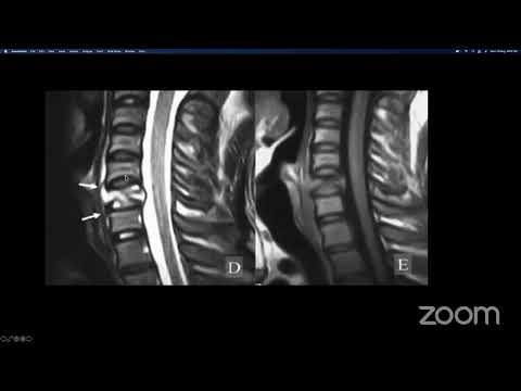 Neurorradiología de Linfomas , tumores hematopoyeticos e histiociticos - Marcelo Castañeda, MD