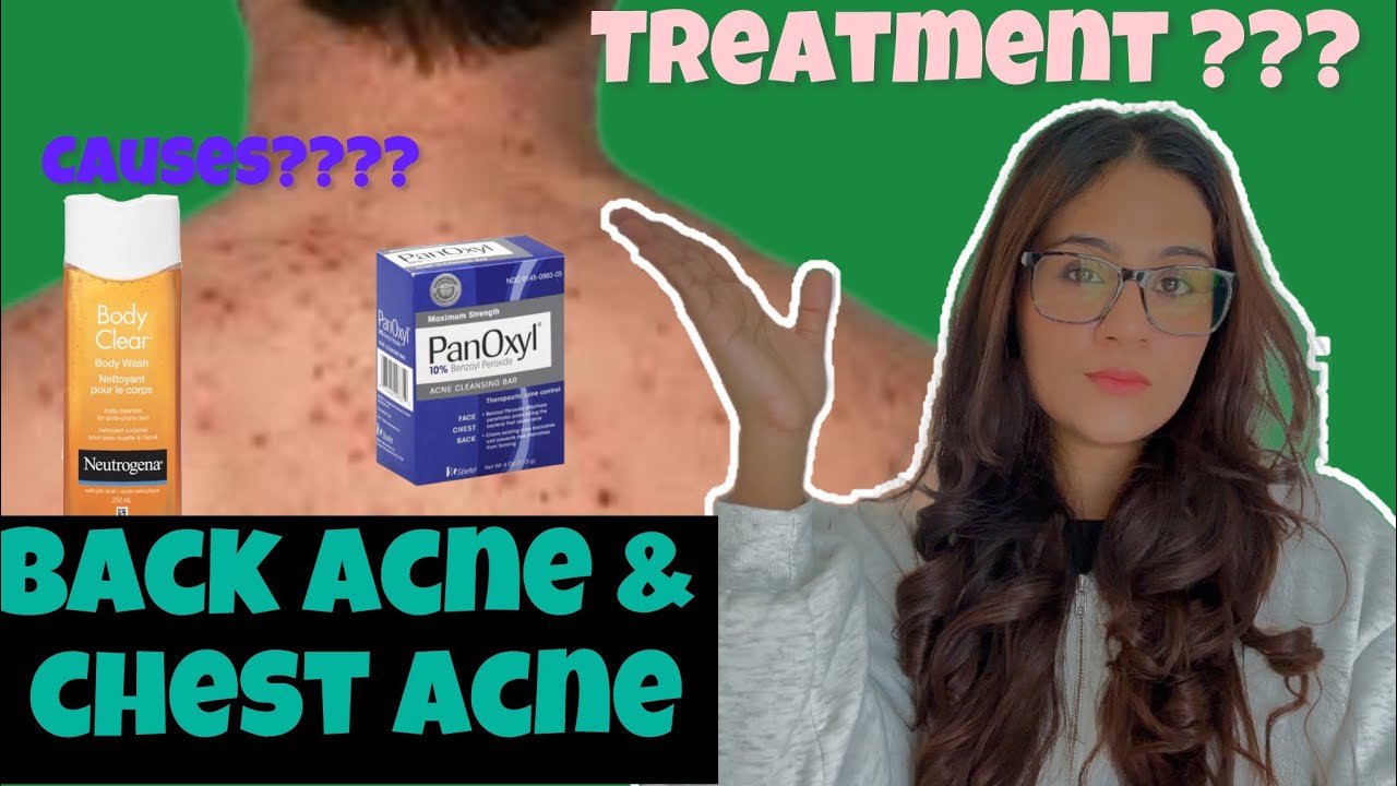 How to Clear Back Acne, Chest Acne | Get Rid Of Back Acne 