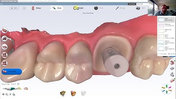 planmeca implant workflow