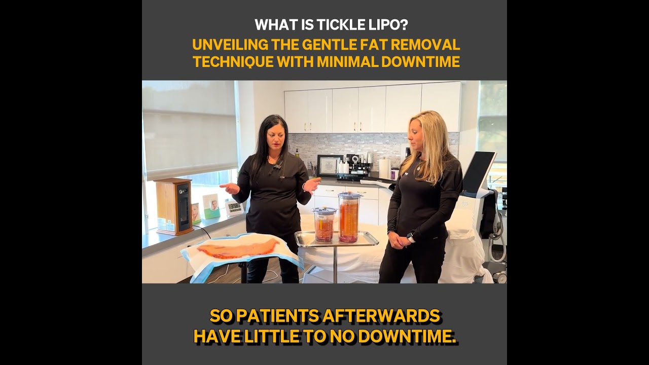 The Soft Touch of Tickle Lipo: Maximizing Results, Minimizing Recovery