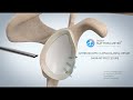 Arthroscopic shoulder stabilisation bankart procedure  dr matthieu meyer  paris france