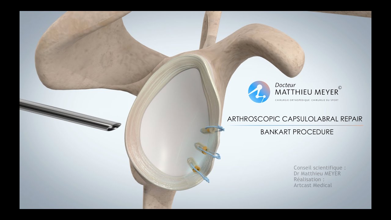 ARTHROSCOPIC SHOULDER STABILISATION BANKART PROCEDURE   DR MATTHIEU MEYER   PARIS FRANCE