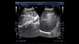 Adrenal Mass with a hepatic Mass.