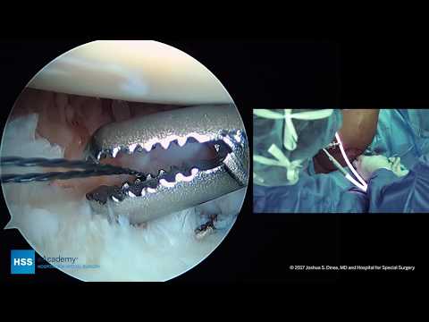 Arthroscopic Shoulder Stabilization: Bankart Repair