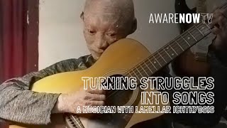'Take A Shoulder' Elsar Dwiman Interview (Music & Lamellar Ichthyosis)