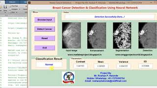 Breast Cancer Detection using Neural Network
