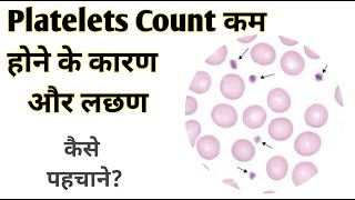 Low platelets symptom II Low platelets causes