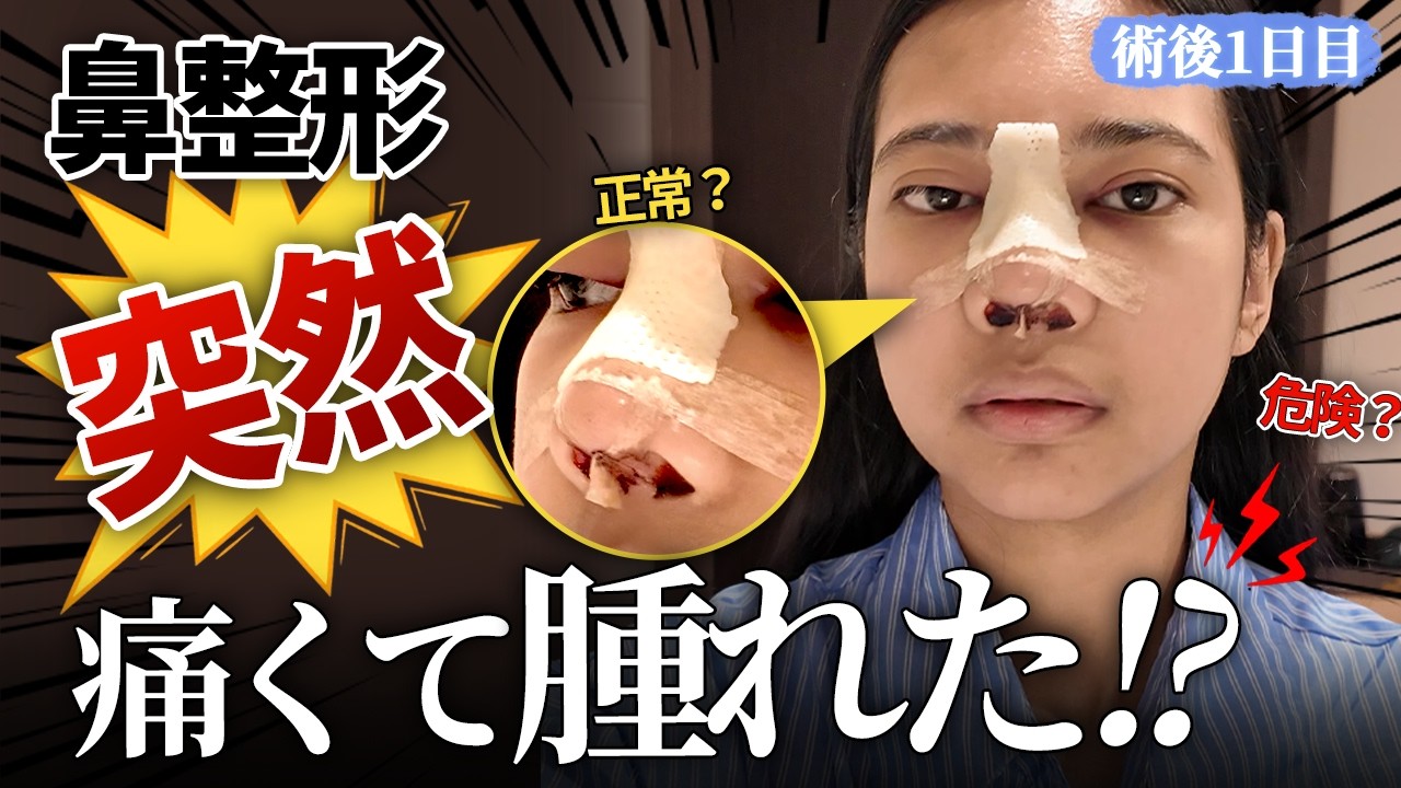 #鼻整形 #鼻整形ダウンタイム #鼻整形後 #腫れ #美容整形 #ジェイジュン美容外科