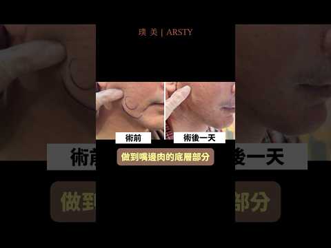 嘴邊肉好顯老怎麼辦?拯救下垂嘴邊肉,你可以這樣做!|#荊偉政醫師 #嘴邊肉 #口內取脂 #筋膜拉皮