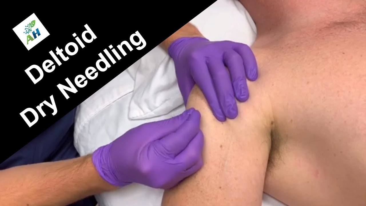 Dry Needling Twitch Response Deltoid | Deltoid Muscle Twitch