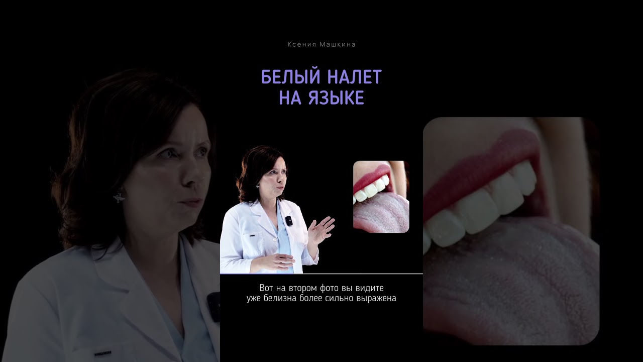 О чем говорит белый налет на языке? 👅
