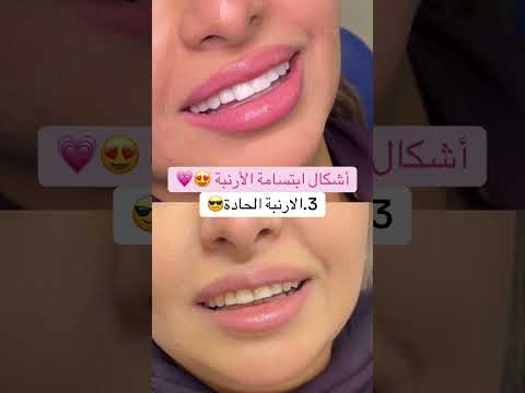أشكال ابتسامة الأرنبة اكسبلور ترند تجميل Dentist تيك توك السعودية أرنب الامارات