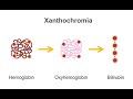 Analyzing gross appearance and cell count of cerebrospinal fluid