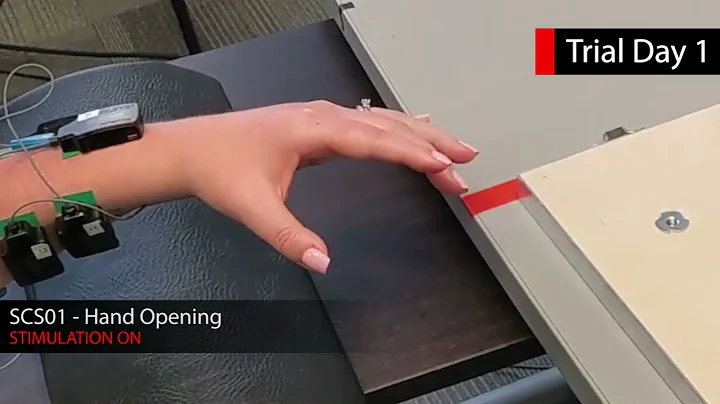 Range of Motion Tests – Spinal Cord Stimulation Instantly Improves Arm Mobility After Stroke