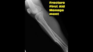 Fracture | Fracture of Bone and First Aid Treatment