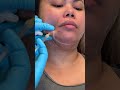 Kybella Dissolving Fat at the Best Med Spa in San Antonio