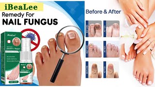 Nail Fungus Treatment Essence Serum Hand Care Foot Fungus Removal Repair Gel Anti Infective