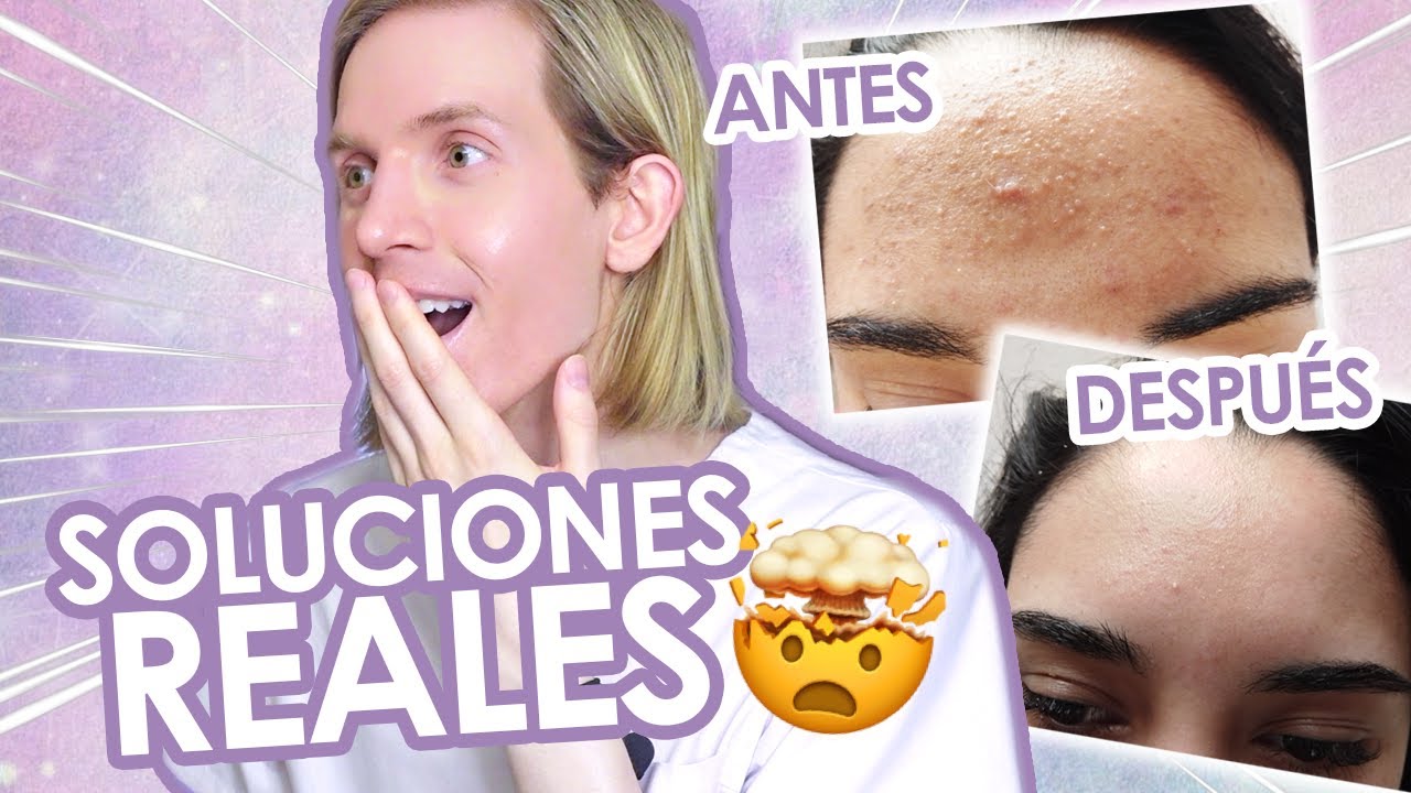SIGUIERON LOS CONSEJOS de mis VIDEOS y ASÍ QUEDÓ SU PIEL - Antes y después de SUSCRIPTORES 🤯 - Simon
