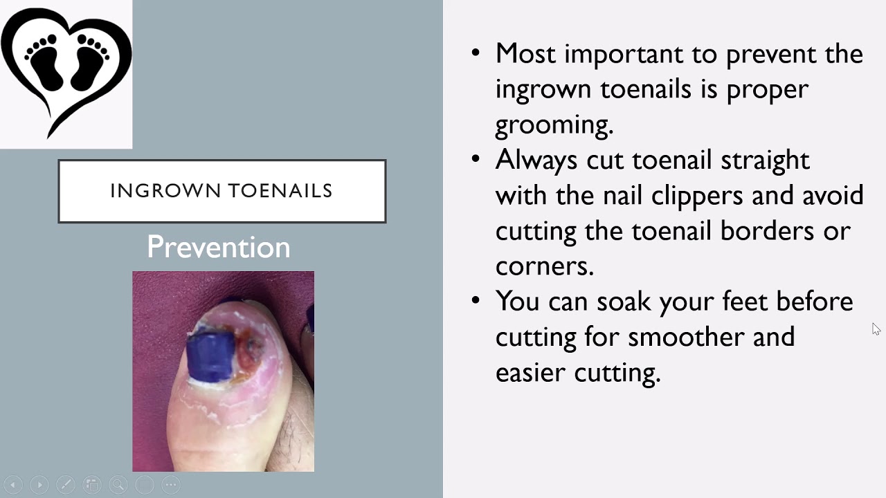 Ingrown Toenail Information /Symptoms/Treatment/After Care - YouTube