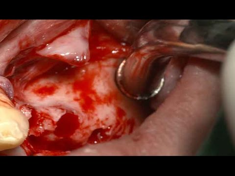 Sinus elevation and implant placement in case of Chronic sinusitis (Short) - Dr. Park Won bae