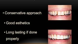 Class 4 Distal Incisal Composite on #9 - Instruction by Dr. Joel N. Janis