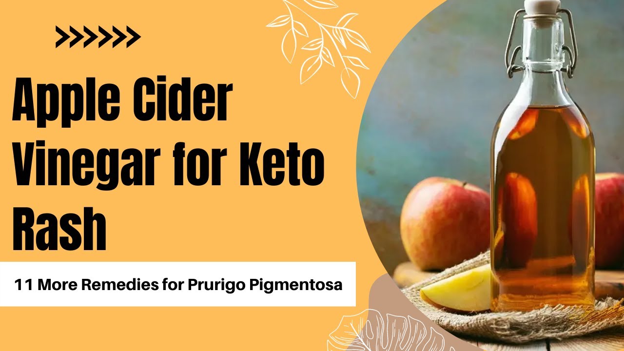 Apple Cider Vinegar for Keto Rash & 11 More Remedies for Prurigo