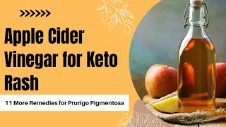 Apple Cider Vinegar for Keto Rash & 11 More Remedies for Prurigo Pigmentosa