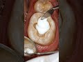 Huge Deep Hole in Tooth Filled! 😱 Satisfying Cavity Restoration #fyp #youtubeshorts