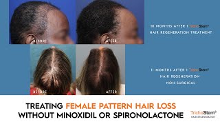 How Female Pattern Hair Loss can be Treated Without Minoxidil or Spironolactone