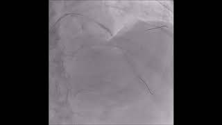 Calcified Mid LAD Lesion Using Scoreflex Balloon and Proximal Optimization Technique